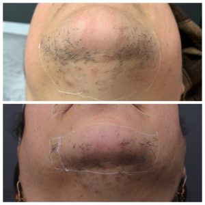 laser-hair-removal-faqs-3-aeena-youth-clinic