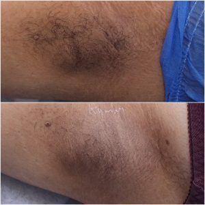 laser-hair-removal-faqs-4-aeena-youth-clinic